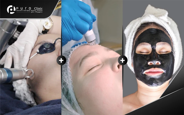Clarity Laser + Pre-Laser Aqua Rejuve Facial + Peel-Off Mask (Paket New Customer) di Puro Clinic