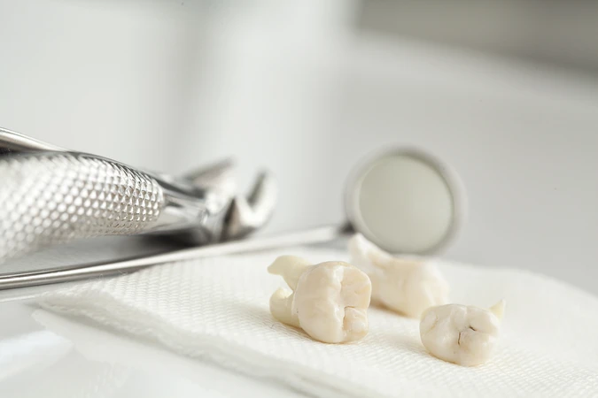 Cabut Gigi Bungsu Kasus Ringan di Kala Dental Studio