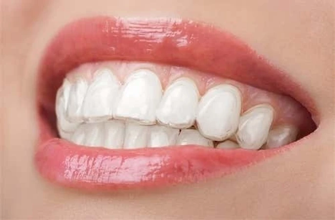 Direct Veneer di Kini Dental