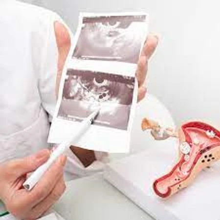 USG 2D Transvaginal Print di RS Kartika Husada Jati Asih
