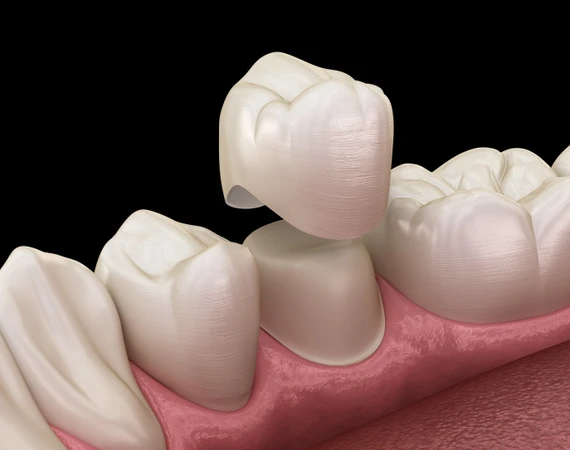 Crown Bahan Zirconia Per Gigi oleh drg. Umum di Passion Dental Care