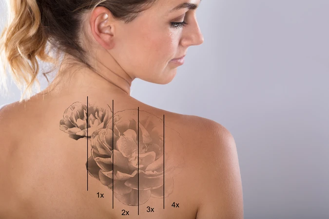 Laser Tatto Removal di Indria Beauty