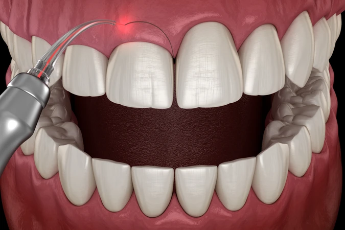 Gingivektomi per gigi oleh drg. Spesialis Periodontik di AS Dental Clinic