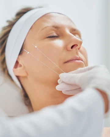 Threadlift di NULOOK Anti Aging & Regenerative Center