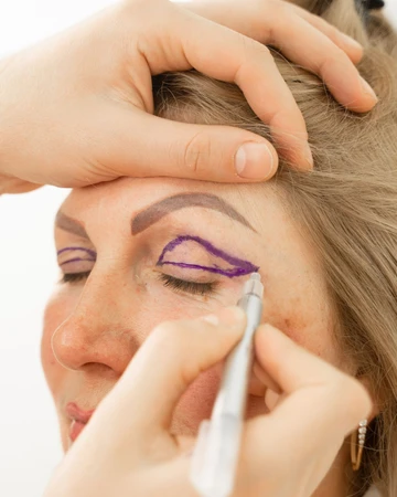 Upper Blepharoplasty di NULOOK Anti Aging & Regenerative Center