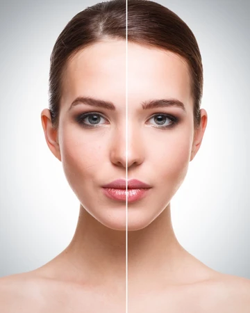 Liposuction : V-line Face di NULOOK Anti Aging & Regenerative Center
