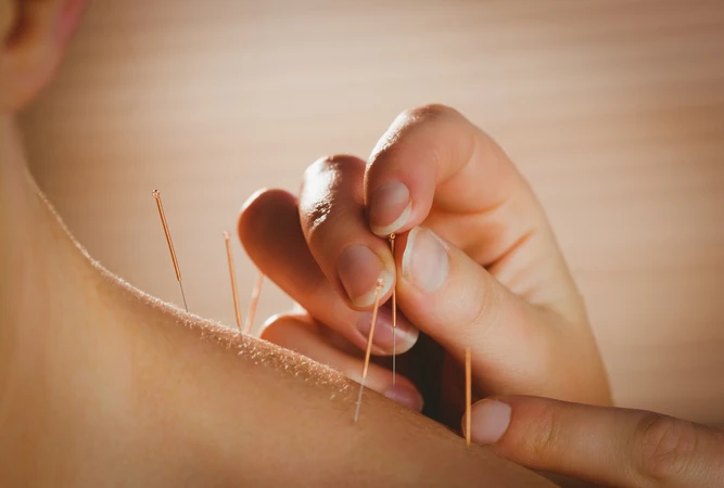 Dry Needling >10 Jahitan di AIC Physiotherapy Clinic