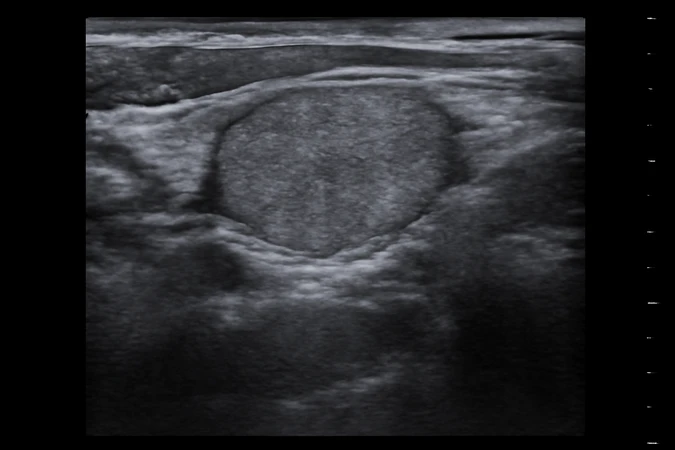 USG Tiroid (Leher) di Amalia Medical Center