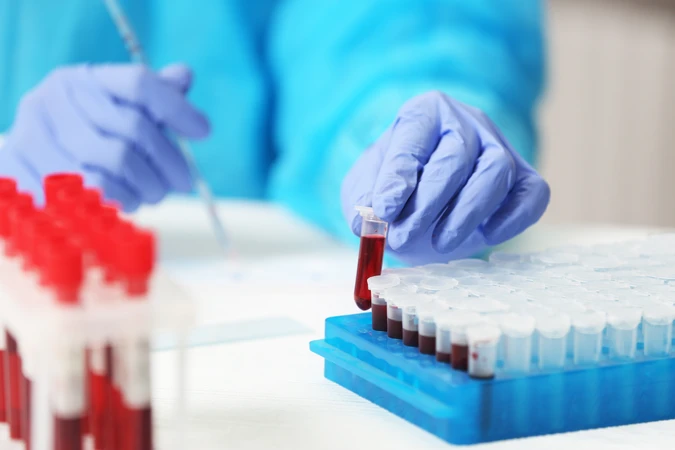Pemeriksaan Tumor Marker EBV-VCA IgA di C-Lab