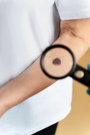 Milia / Mole Removal / 3 Titik (Electrocauter) di Kontura Aesthetic Clinic