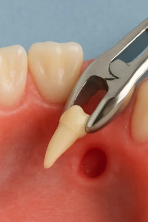 Odontectomy di NUI Dental Studio