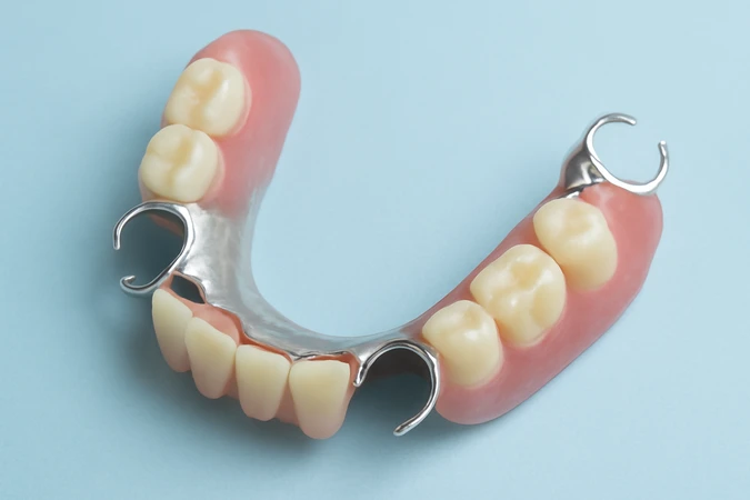 Pemasangan Gigi Palsu Lepasan - Metal di NUI Dental Studio