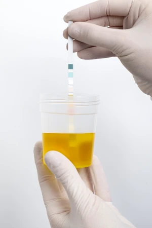 Pemeriksaan Urine Lengkap di Klinik Utama Althea Vita