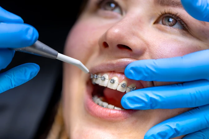 Pasang Behel Metal USA oleh drg. Umum di Indonesia Clinic & Dental