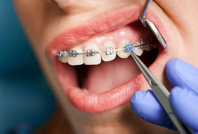 Pasang Behel Metal Self-Ligating di NK Health
