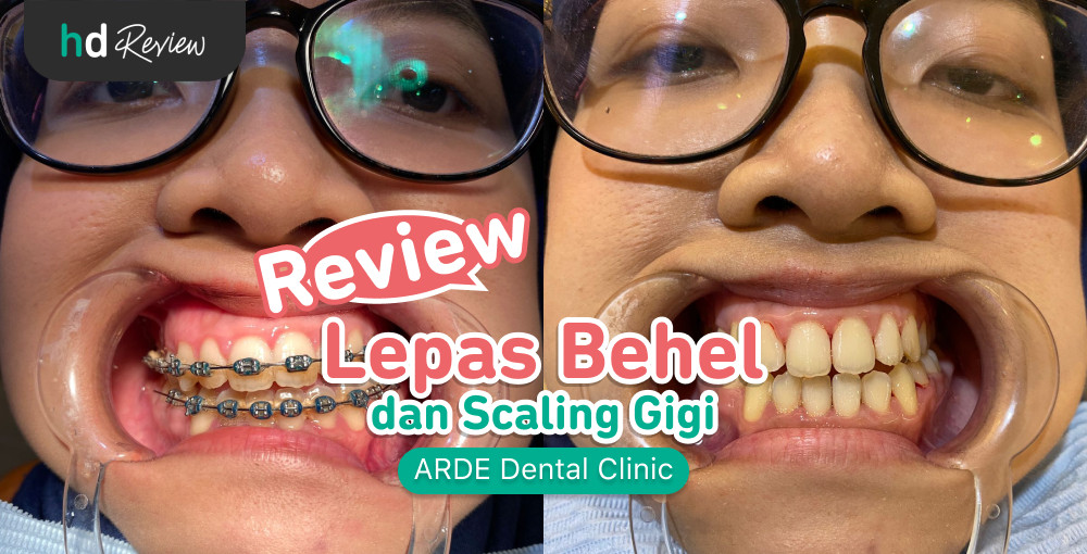 Review Lepas Behel Di Arde Dental Clinic Hdmall